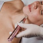 microneedling