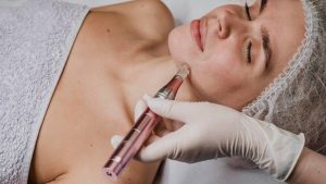 microneedling