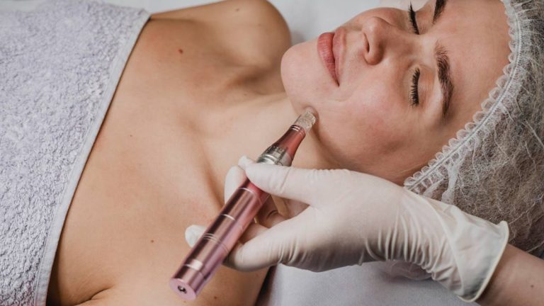 microneedling